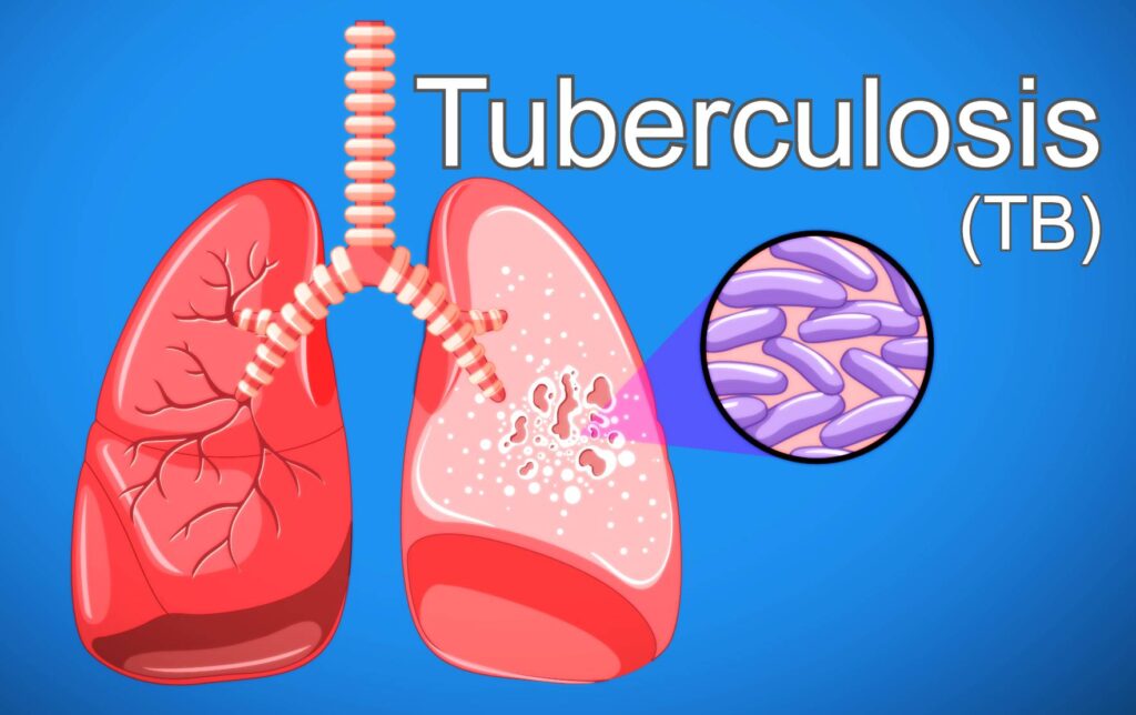 Illustration of tuberculosis-infected lungs, showcasing the impact of the bacteria.